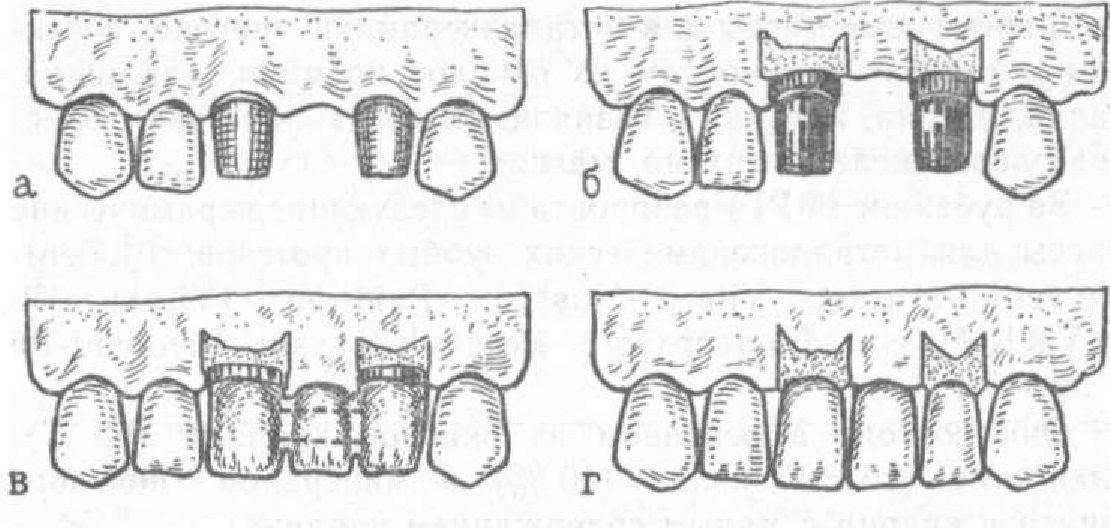 Мостовидные протезы этапы. Препарирование опорных зубов под мостовидные протезы. Препарирование опорных зубов под паяные мостовидные протезы. Нарисуйте опорные зубы, отпрепарированные под мостовидный протез.. Консольный мостовидный протез.