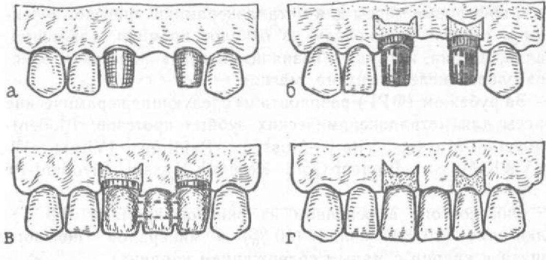 Мостовидные Протезы И Их Виды Фото Цена
