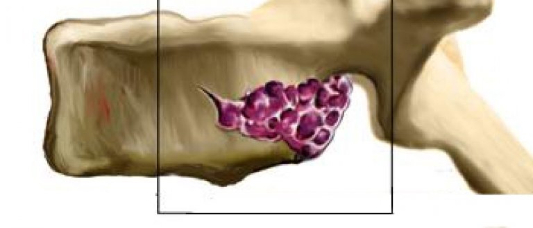 Гемангиома тела l2 позвонка что это такое и лечение фото