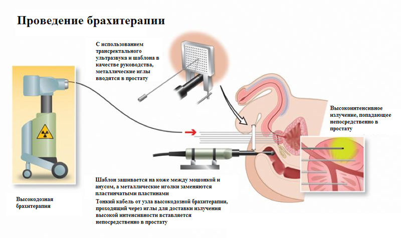 Облучение прямой кишки схема лечения