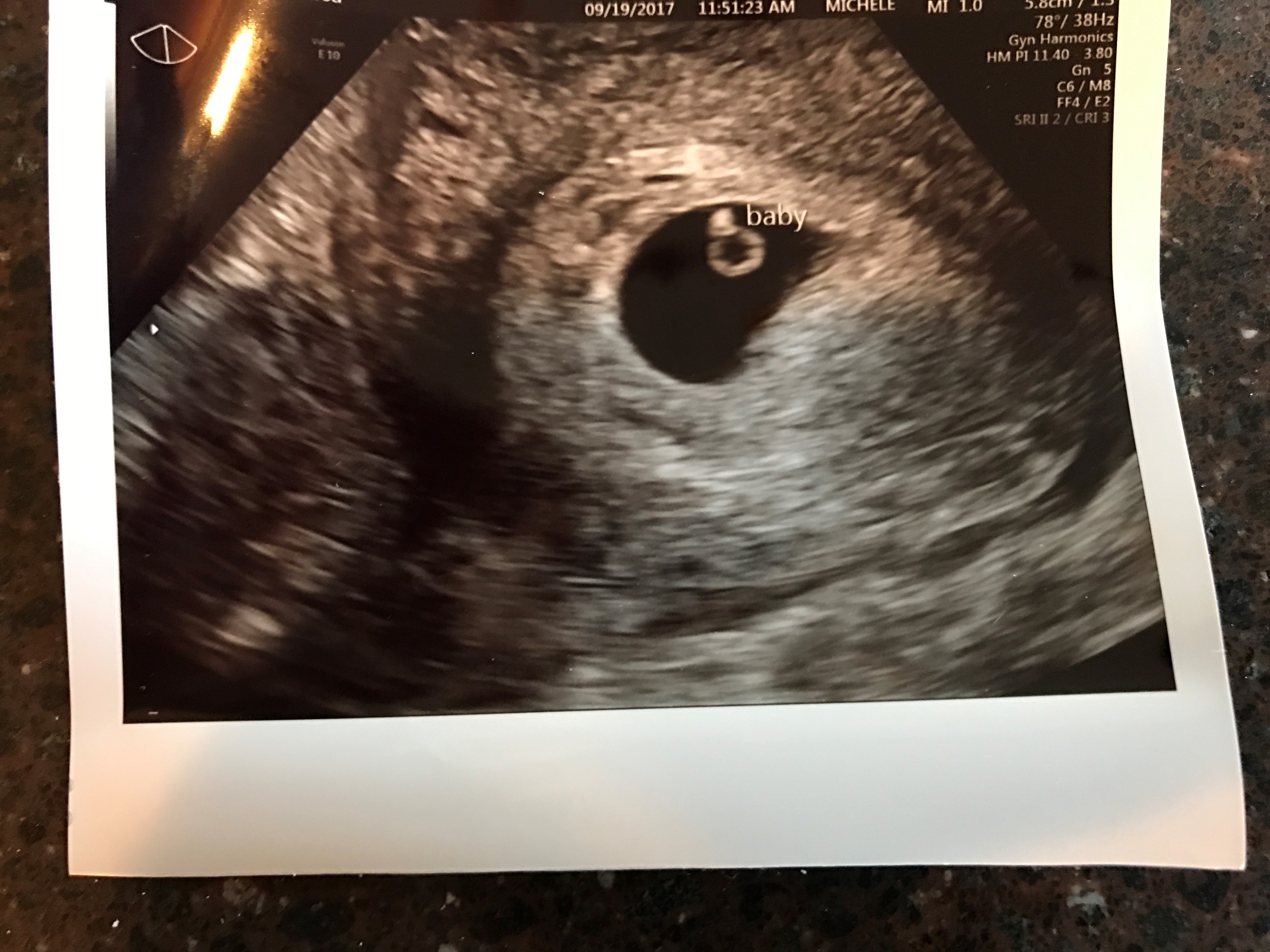 После первого узи. УЗИ после подсадки эмбрионов. Снимок УЗИ после переноса эмбриона. УЗИ 3 недели беременности эко.