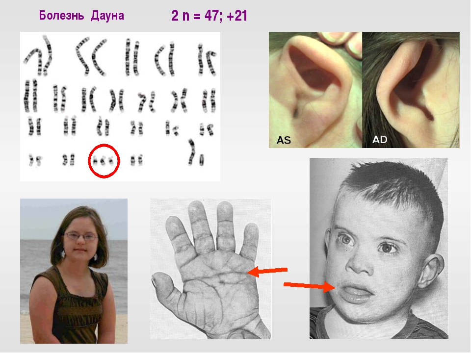 Три дауна. Фенотипические проявления синдрома Дауна. Внешние проявления синдрома Дауна.