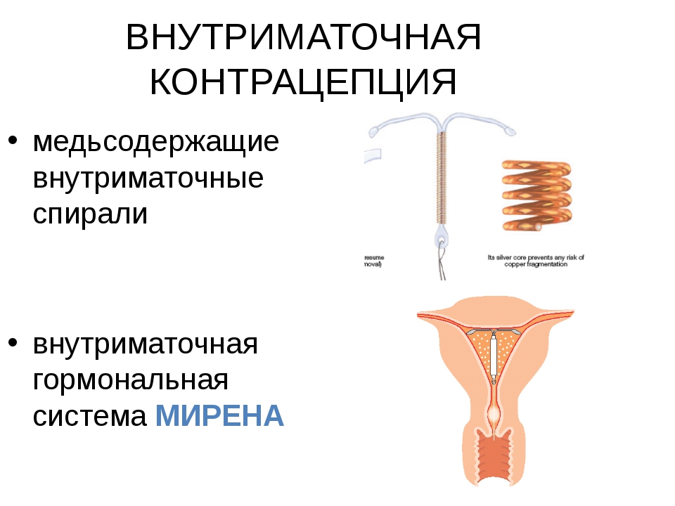 Виды спиралей. Внутриматочные противозачаточные спирали. Контрацепция: внутриматочная спираль (ВМС). Медьсодержащая внутриматочная спираль. Медьсодержащие внутриматочные контрацептивы (ВМК).