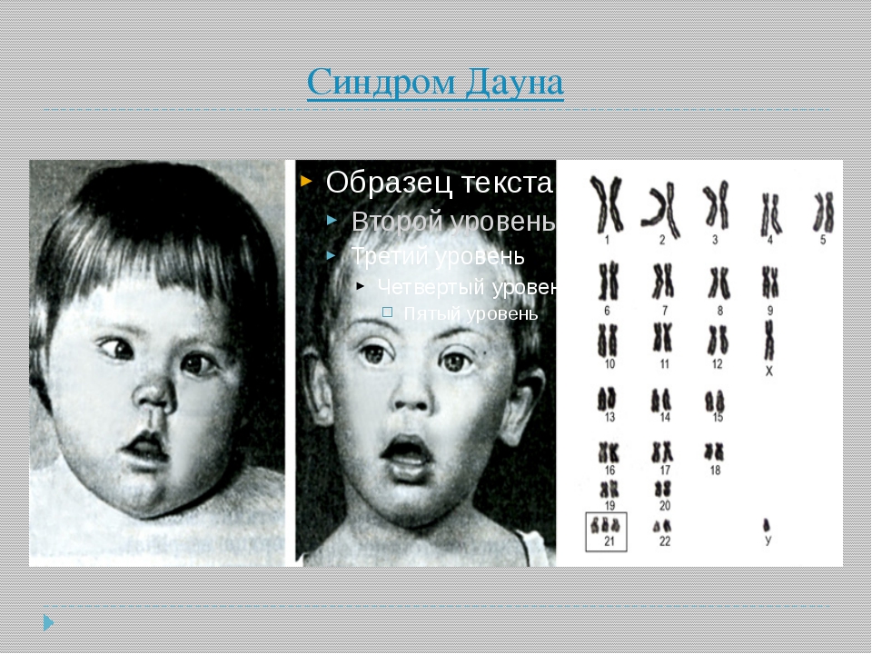 46 хромосом 1. Синдром Дауна схема хромосом. Болезнь Дауна кариотип. Синдром Дауна карта хромосом. Синдром Дауна трисомия.
