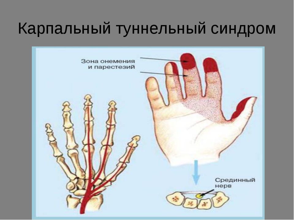 Синдром карпального канала мкб 10. Туннельный синдром лучезапястного сустава. Туннельный карпальный синдром руки. Карпальный туннельный синдром кисти. Синдром запястного (карпального) канала.