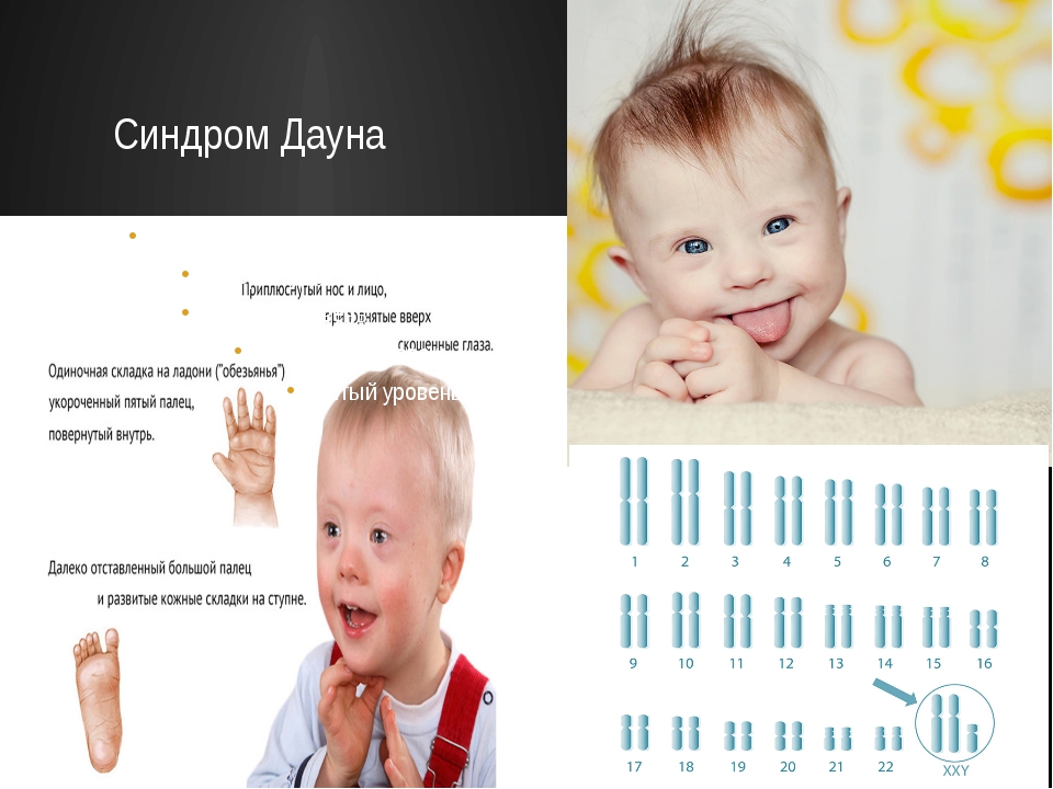 Дауны на первом. Синдром Дауна признаки у детей. Новорождённые дети с синдромом Дауна. Синдром Дауна в легкой форме.
