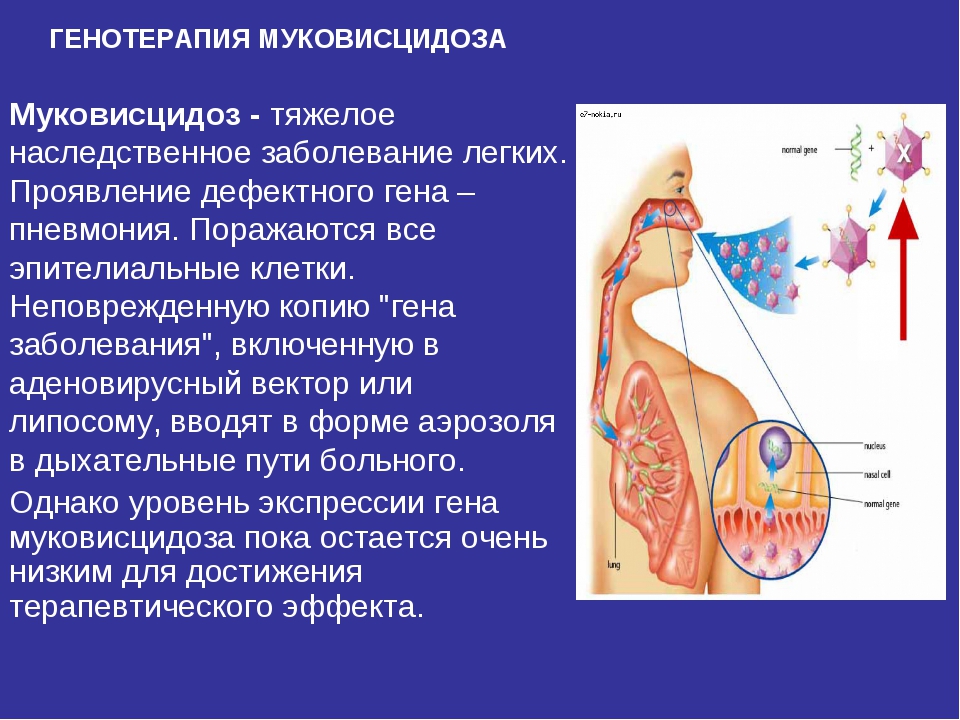 Муковисцидоз что это за болезнь. Заболевание муковисцидоз. Муковисцидоз смешанная форма. Наследственное заболевание муковисцидоз.