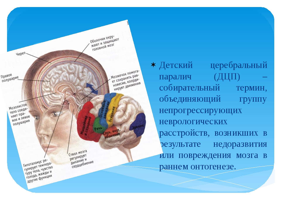 Дцп поражение. Поражение мозга при ДЦП. Формы детского церебрального паралича. Понятие ДЦП. Детский паралич головного мозга.