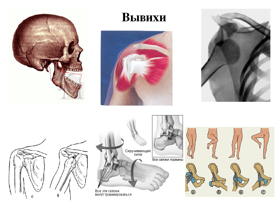 Картинка вывиха сустава