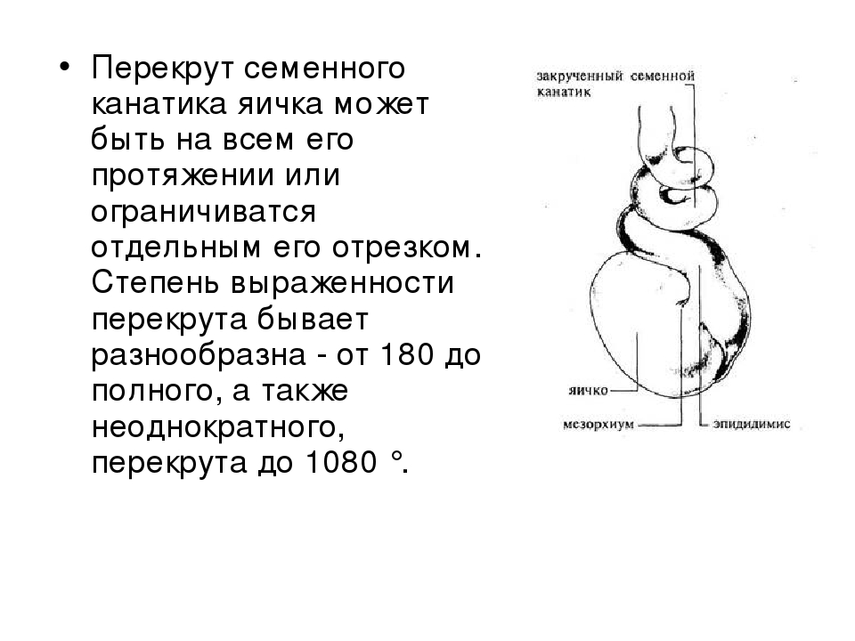 Почему болят яйца. Перекрут семенного канатика. Перекрут канатика яичка. Перекручивание семенного канатика. Семенной канатик перекрутился.