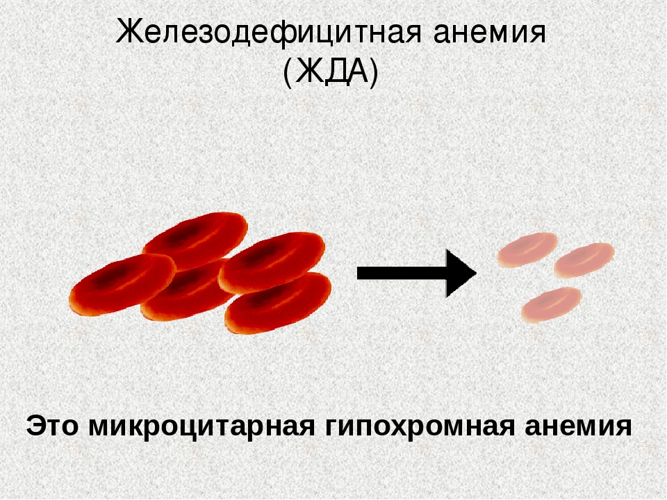 Презентация на тему железодефицитная анемия у детей