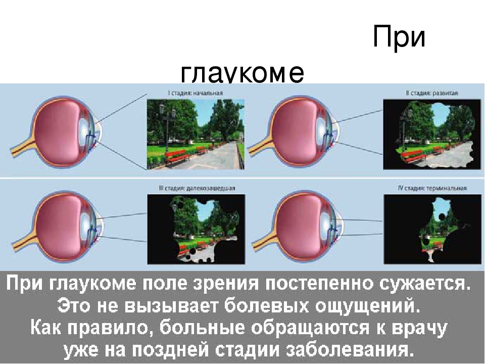 Стадии зрения. Поля зрения при разных стадиях глаукомы. Зрение при глаукоме. Стадии глаукомы. Стадии развития глаукомы.