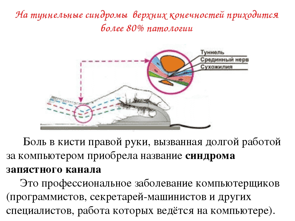 Туннельный синдром запястного канала. Тоннельный синдром запястного нерва. Туннельный синдром (синдром запястного канала). Кистевой туннельный синдром. При туннельном синдроме.