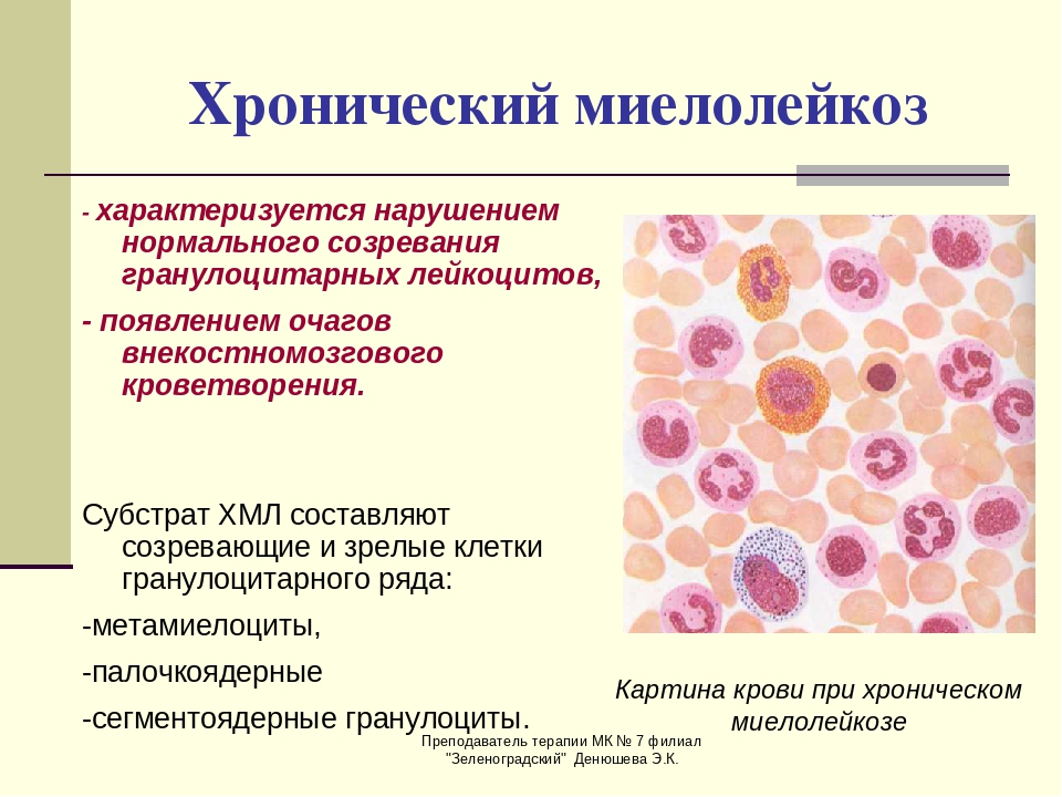 Анализ крови на мозг. Хронический миелолейкоз показатели лейкоцитов. Миелоцитарный лейкоз картина крови. Хронический миелоидный лейкоз картина крови. Хронический миелолейкоз клинический диагноз.