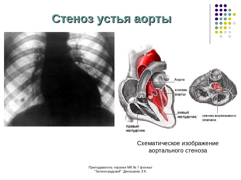 Аортальный стеноз что это такое. Врожденный стеноз аортального клапана клапан. Стеноз аортального клапана клиника. Стеноз аортального клапана клиническая картина. Стеноз аортального клапана 2 степени.