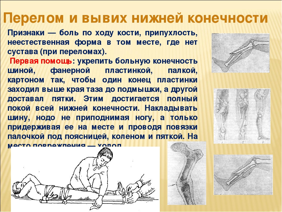 Переломы верхних конечностей презентация