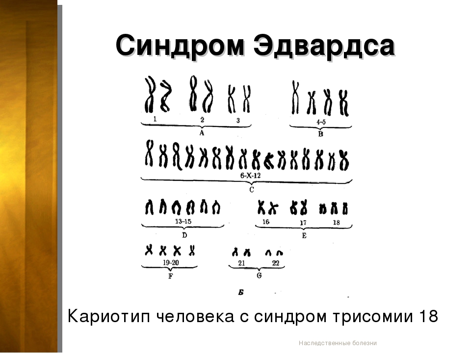 Кариотип характерен для. Трисомия синдром Эдвардса кариотип. Формула кариотипа при синдроме Эдвардса. Кариотип синдрома синдром Эдвардса. Кариотип человека с синдромом Эдвардса.