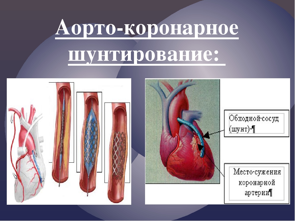 Инфаркт коронарное стентирование. Шунтирование коронарных артерий. Коронарное шунтирование сосудов. Аортокоронарное шунтирование хирургия.