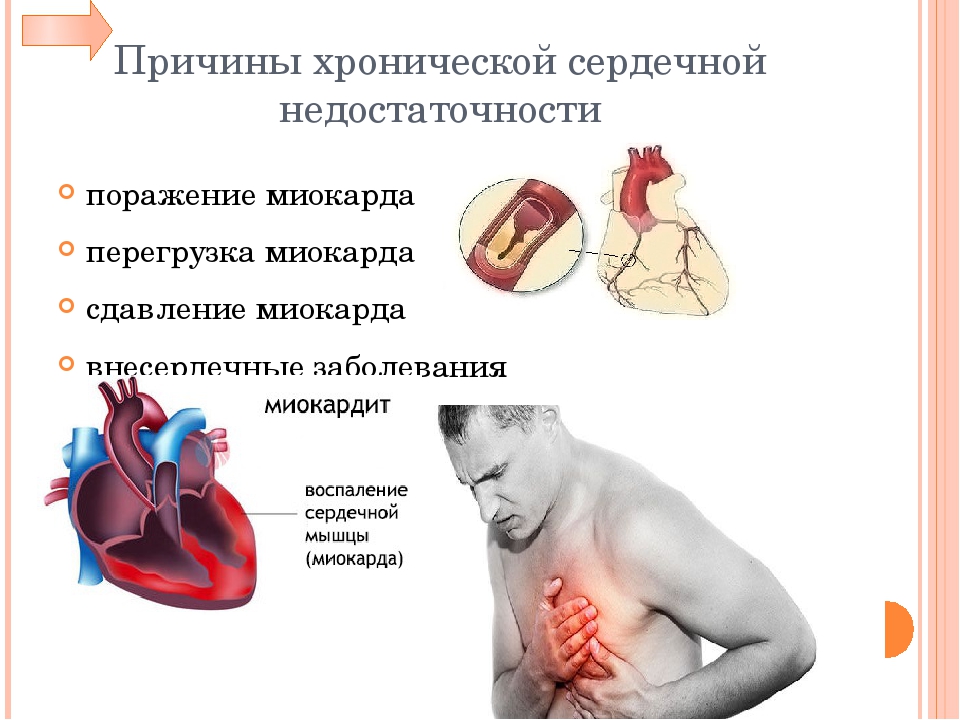 Заболевание сердца сопровождающееся сердечной недостаточностью. Симптомы острой сердечной недостаточности. Причины хронической сердечной недостаточности. Причины развития острой и хронической сердечной недостаточности. Сердечная недостаточн.