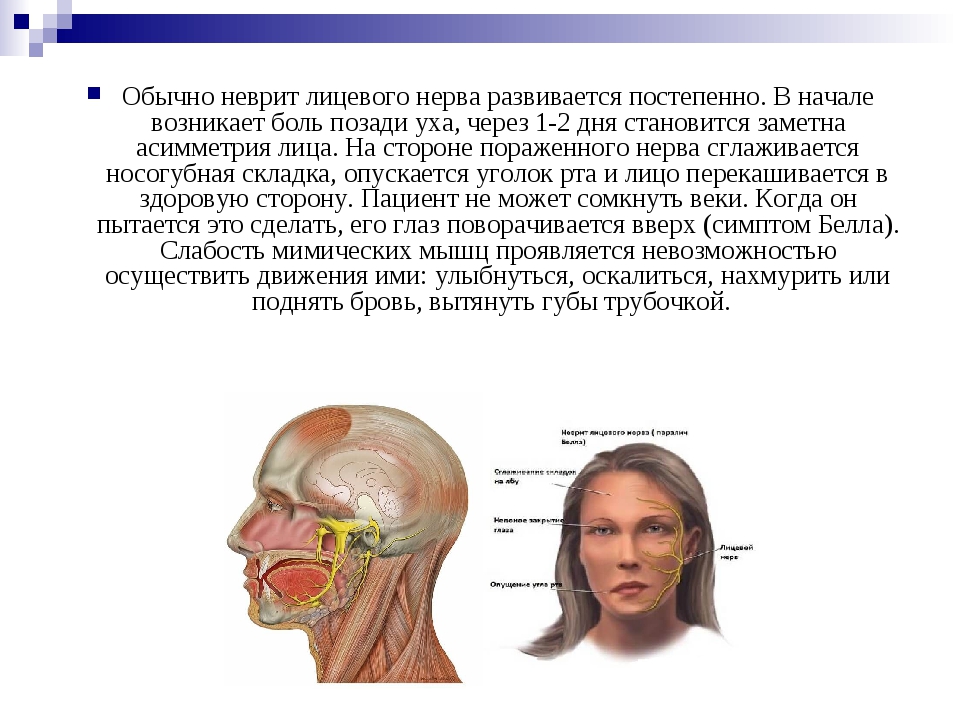 Лицевой нерв после операции. Клинические проявления при неврите лицевого нерва. При неврите лицевого нерва страдают мышцы :. Неврит лицевого нерва тактика фельдшера. Основной синдром при неврите лицевого нерва:.