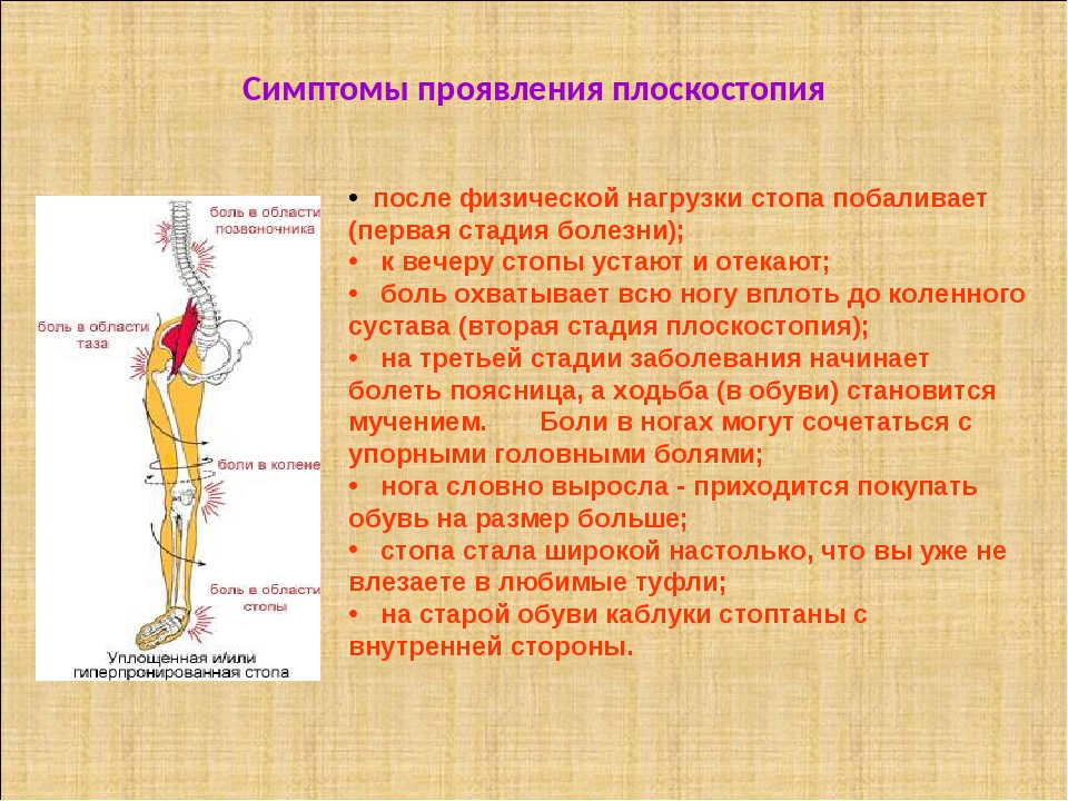 Симптомы плоскостопия. Признаки плоскостопия. Проявление плоскостопия. Плоскостопие клинические проявления. Основной признак продольного плоскостопия:.