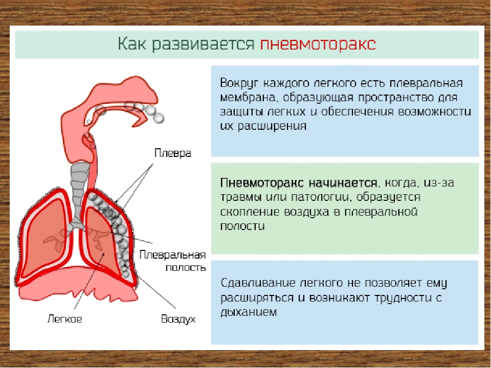 Для удаления воздуха из желудка необходимо. Пневмоторакс открытый закрытый клапанный. Пневмоторакс развивается из-за:. Баротравматический пневмоторакс.