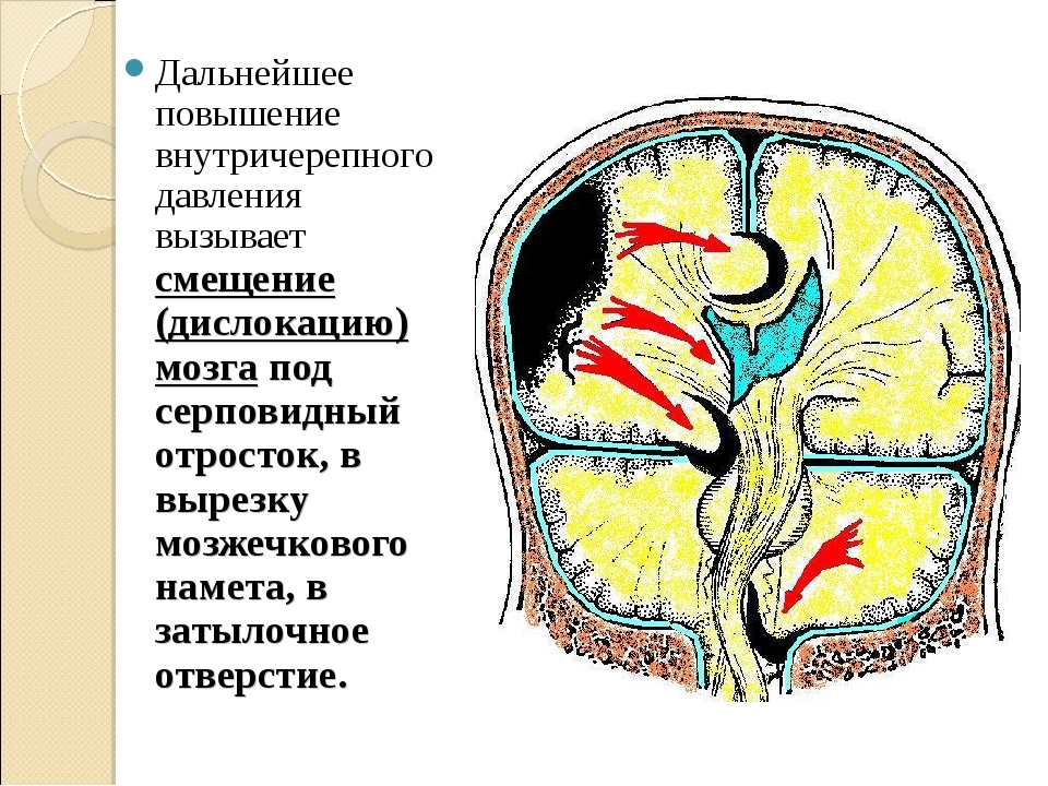 Дислокация мозгах