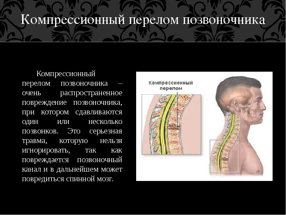 Компрессионный перелом позвоночника что это такое. Компрессионный перелом позвоночника тн6. Компрессионный перелом 6 позвонка. Компрессионный перелом 8 позвонка. Компрессионный перелом 9 позвонка.