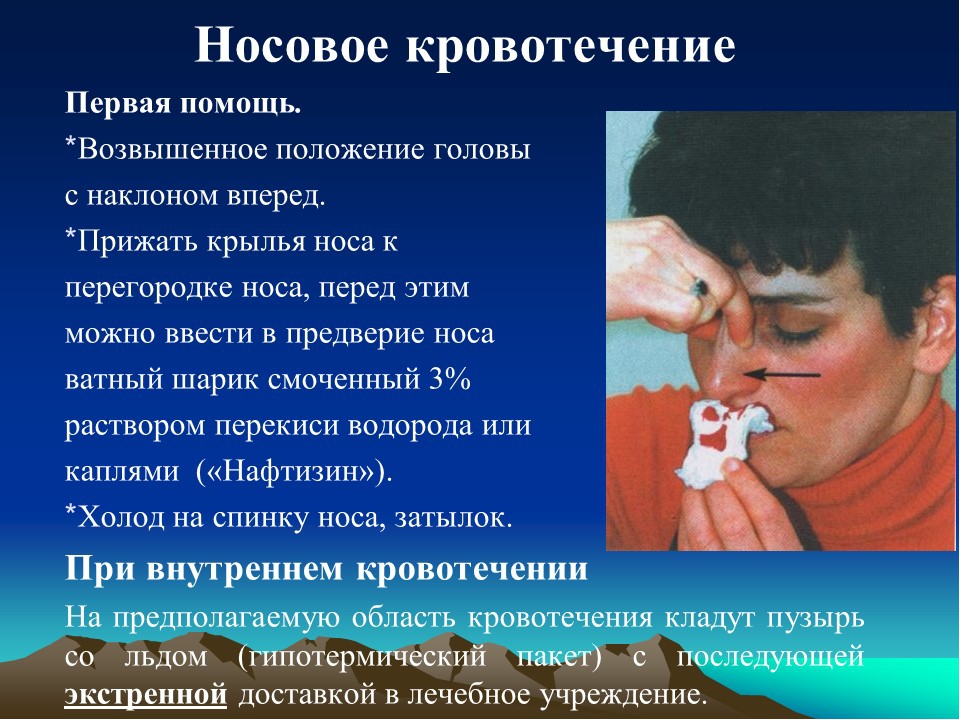 Идет носом. Носовое кровотечение первая. Симптомы носового кровотечения. Симптомы носового кровотечения и первая. Основные причины носового кровотечения.