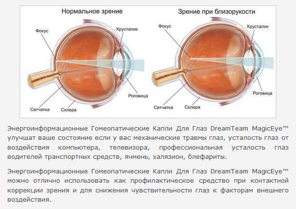 Миопия степени