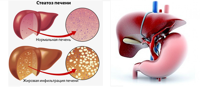 Жировой гепатоз (стеатоз) печени. Жировая инфильтрация печени стеатоз. Болезнь печени стеатогепатоз.