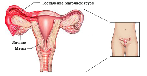 Аднексит