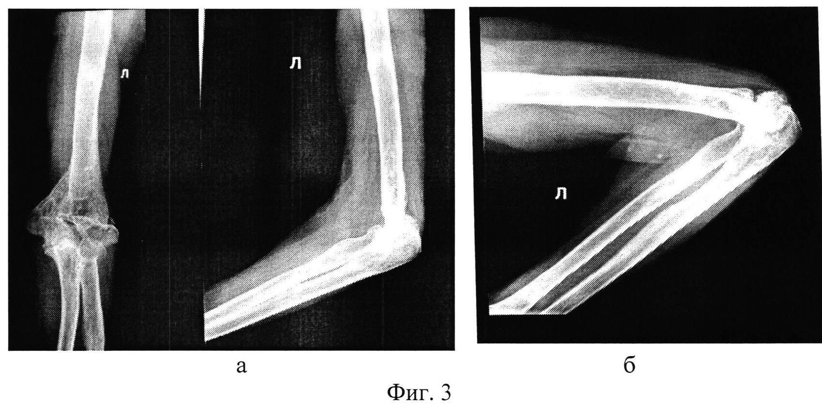 Локтевой мыщелок. Контрактура локтевого сустава на рентгене. Ложный локтевой сустав. Ложный сустав локтевого сустава. Ложный сустав плечевой кости.