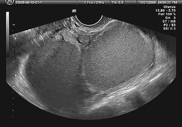 Параовариальная киста на узи фото