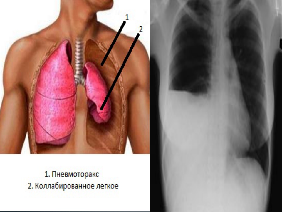 Коллапс легкого это. Рентгенография грудной клетки пневмоторакс. Двусторонний пневмоторакс рентген. Левосторонний спонтанный пневмоторакс. Тотальный пневмоторакс рентген.