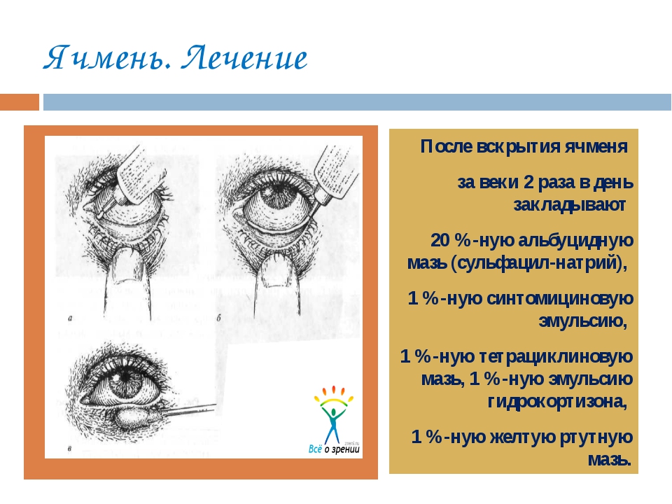 Лечение ячменя на глазу. Ячмень стадии развития глазной. Этапы формирования ячменя на глазу. Внутренний ячмень лечение.