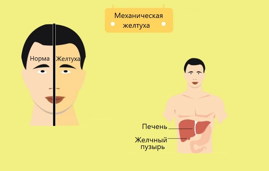 Презентация желтухи у детей