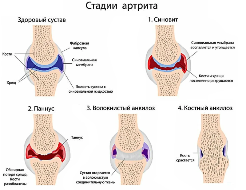 Косточки суставы. Степени ревматоидного артрита. Стадии ревматоидного остеоартрита. Ревматоидный артрит 1 стадия. Стадии ревматоидного артрита паннус.