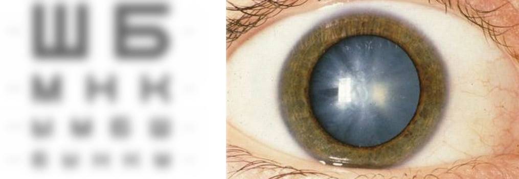 Затуманенное зрение. Спицевидная катаракта. Кольцевидная катаракта Фоссиуса. Сенильная катаракта глаза.