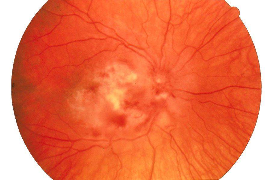 Фото глазного дна при ретините