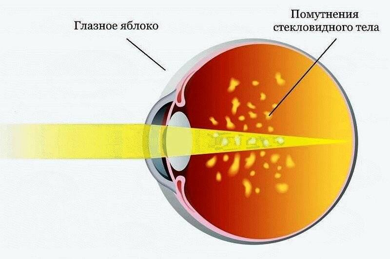 Перед глазами плывет картинка как через линзу