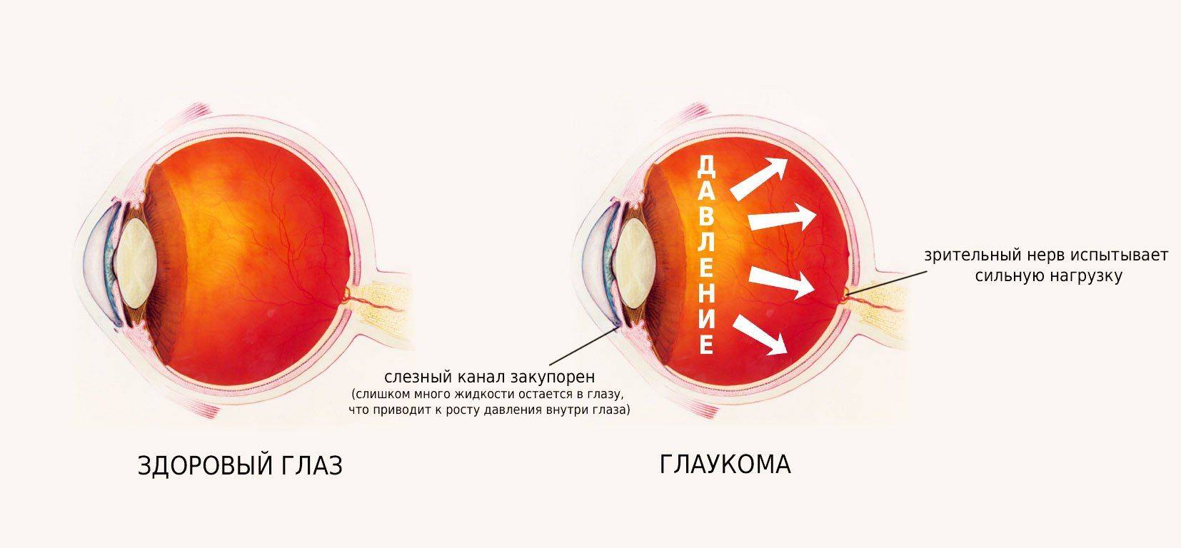 Глаз 0. Глаукома схема.