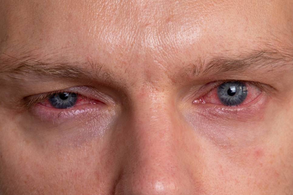 красные глаза от курения марихуаны