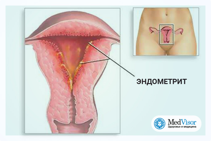 Эндометрит симптомы у женщин