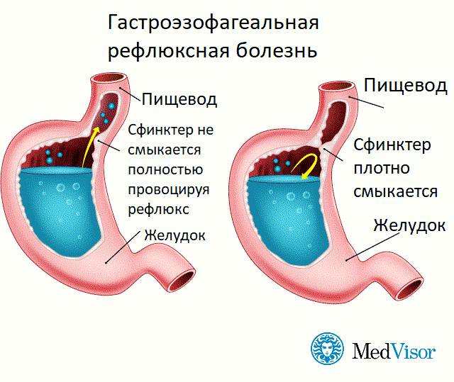 Гастроэзофагеальная рефлюксная болезнь презентация