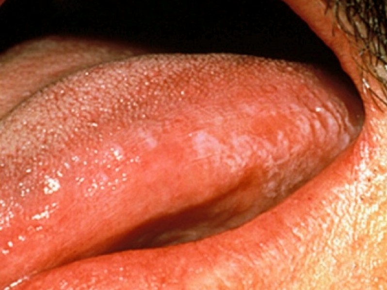 hairy leukoplakia pictures 2
