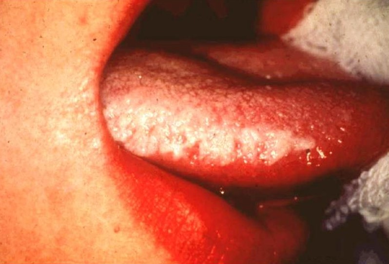 hairy leukoplakia pictures 3