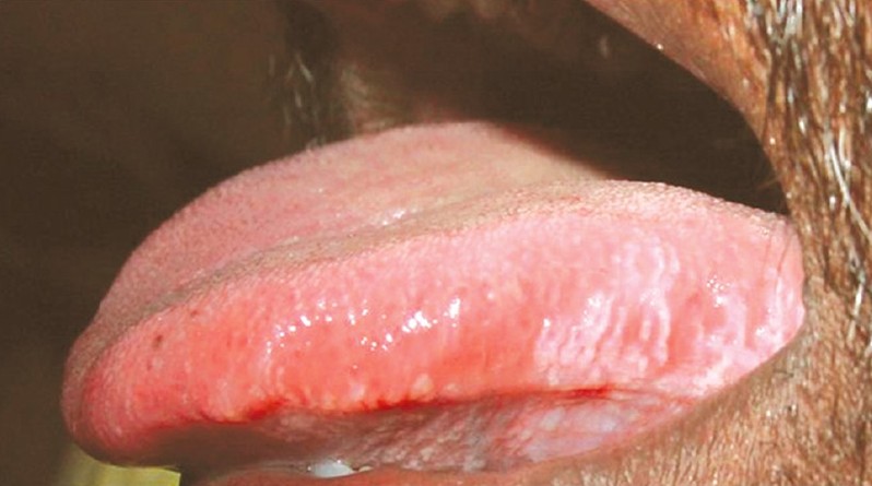 hairy leukoplakia pictures 5