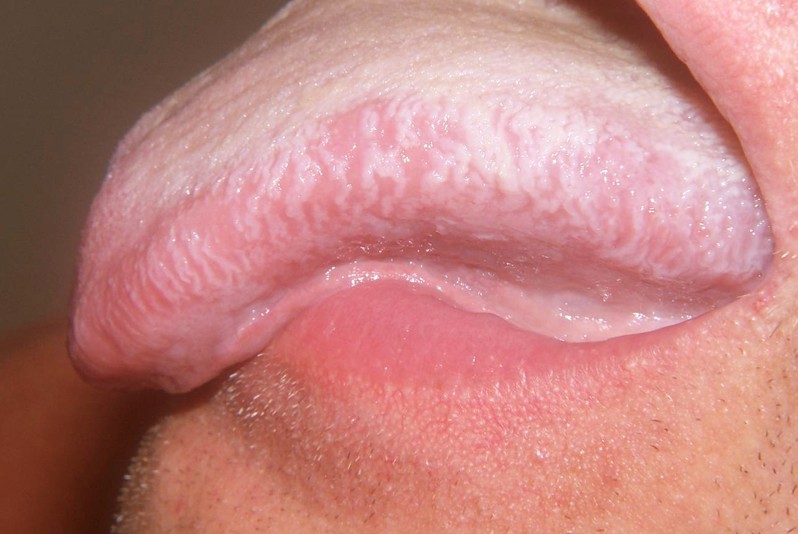 hairy leukoplakia pictures