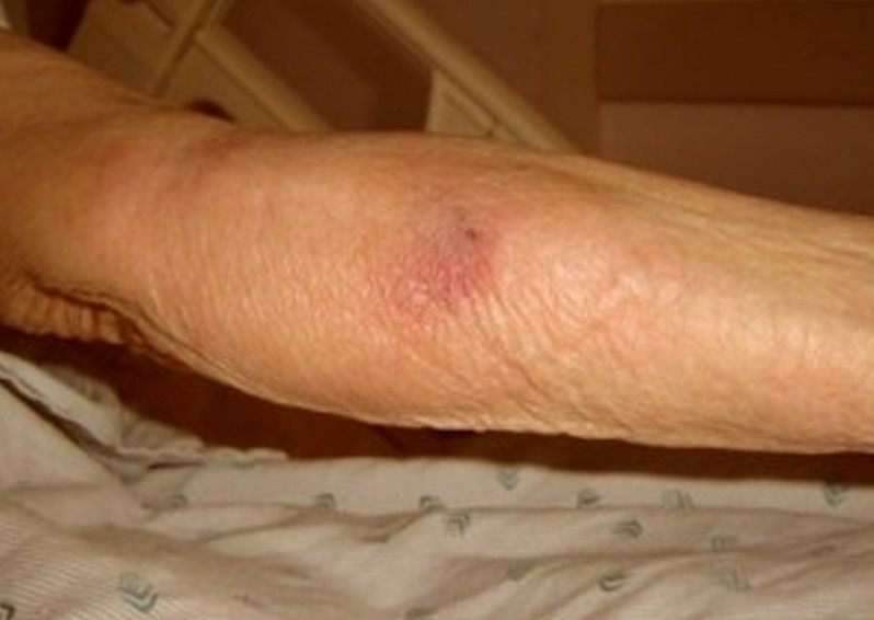 phlebitis pictures 2